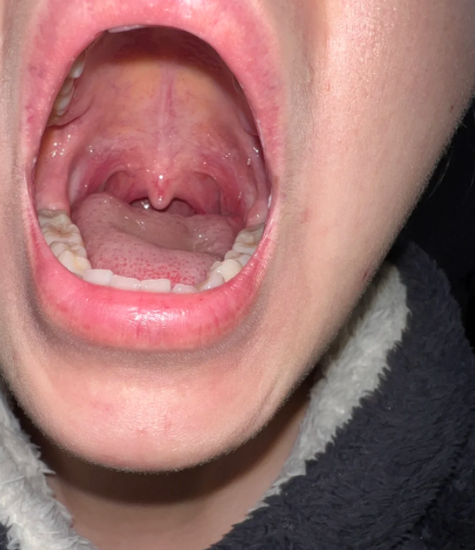 第一种是药物治疗.喉咙发炎声音哑了,通常是细菌或病毒感染引起的