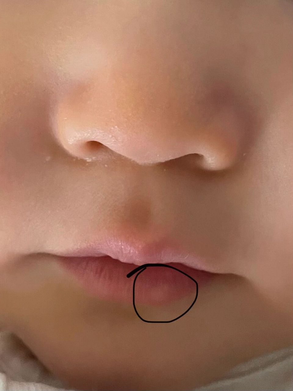 婴儿嘴唇上一块白色圆圆的 万能的有人知道怎么回事吗?