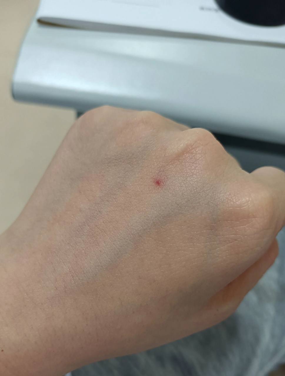 蜘蛛痣? 有同款姐妹吗咋看咋像蜘蛛痣