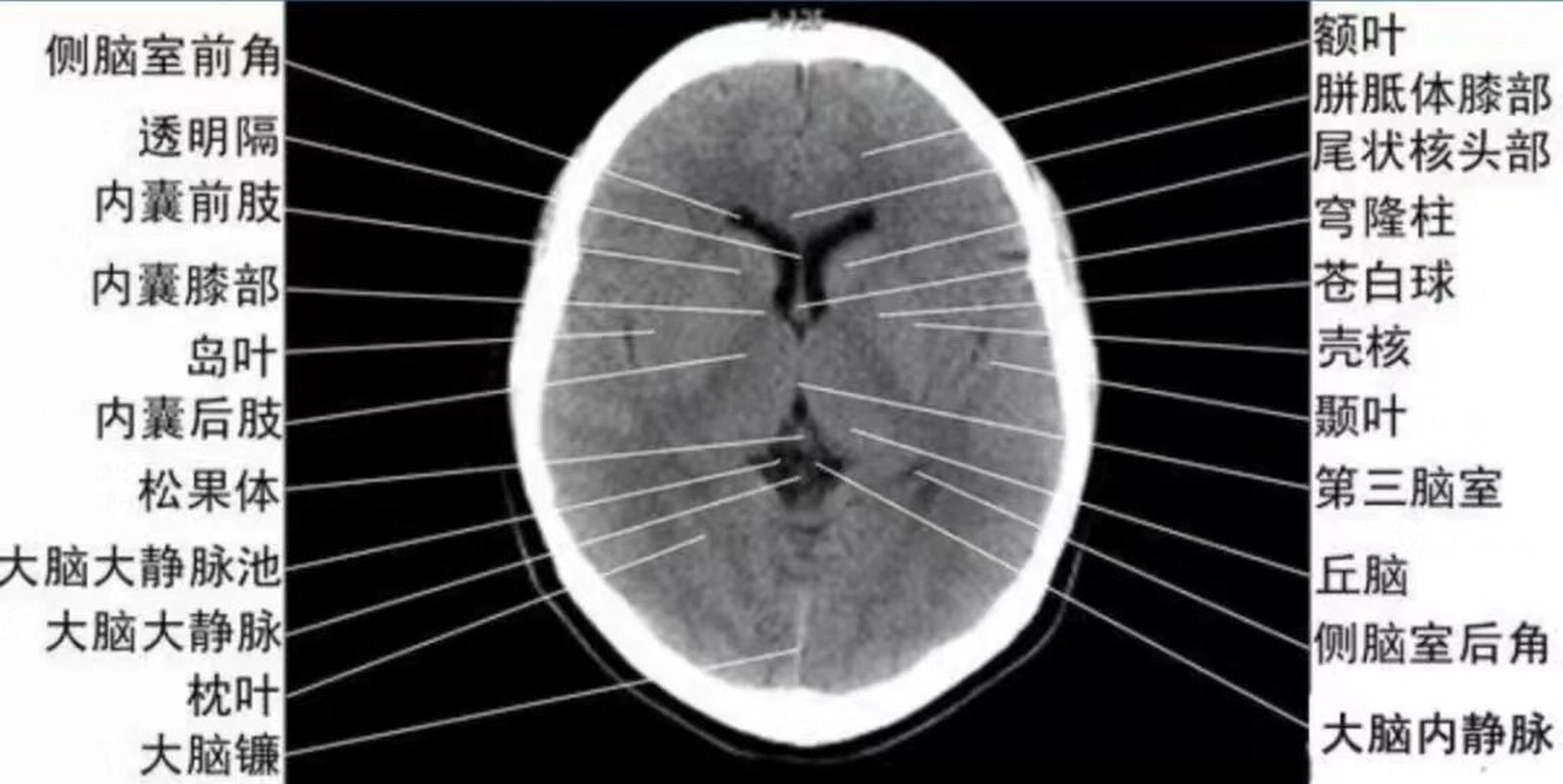 大脑基底节区的解剖08 基底节又称基底核,位于近大脑半球底部的白质