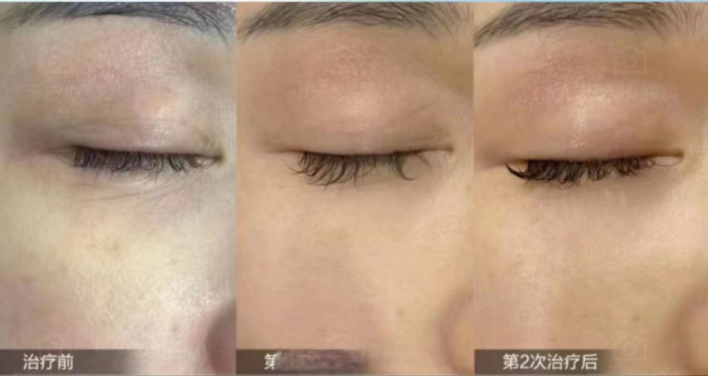 #薇旖美# #眼周抗衰# #干纹细纹#  今天分享两个用薇旖美三型胶原蛋白