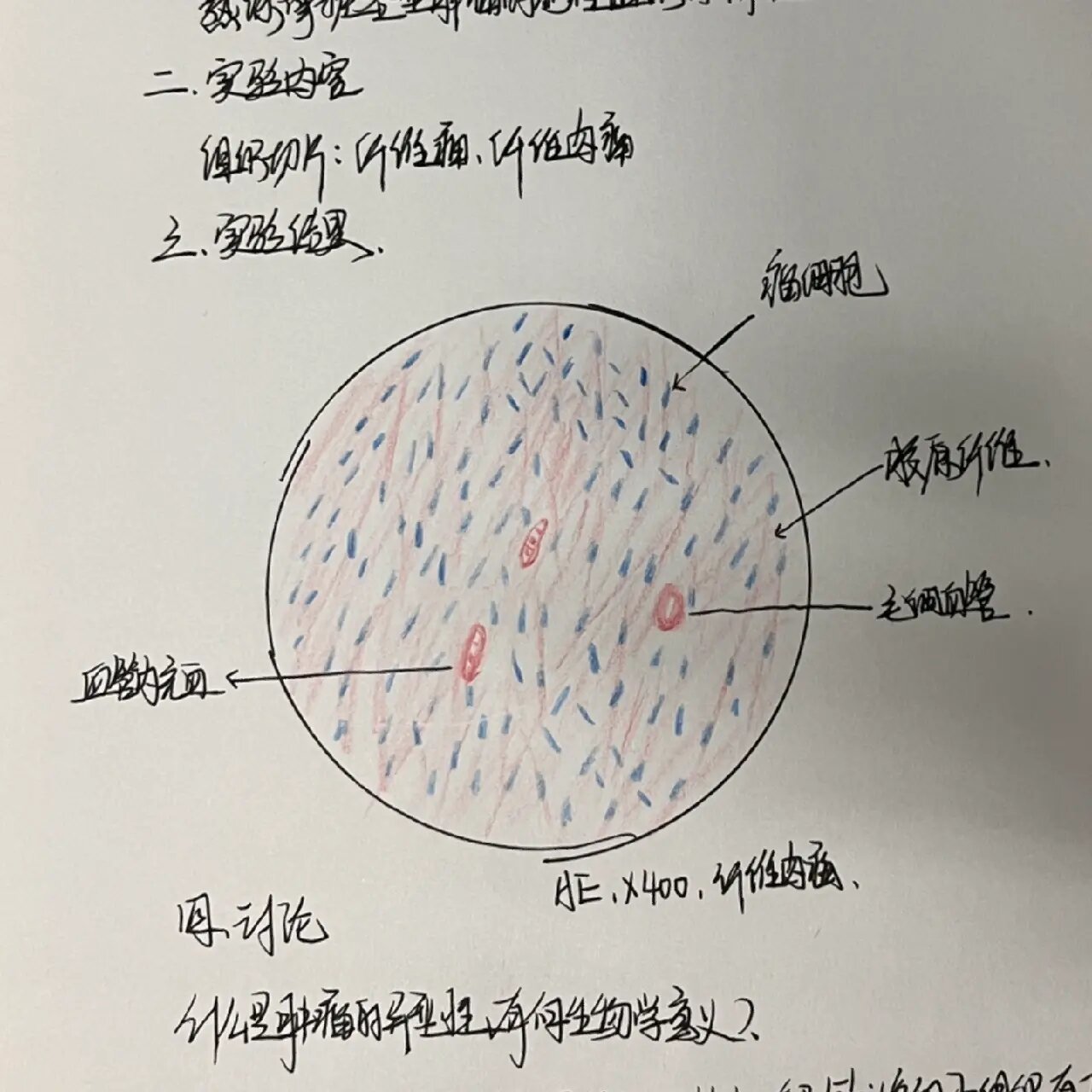 纤维肉瘤手绘图图片