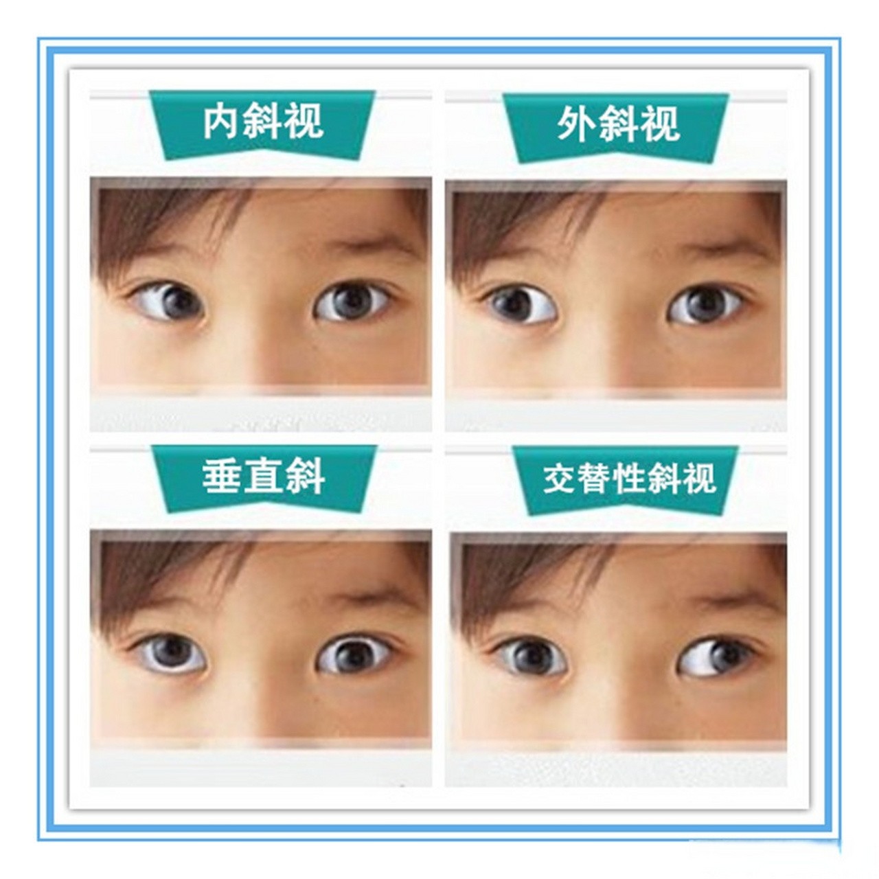 眼健康光明计划# 问答: 1,游医生,斜视是什么?