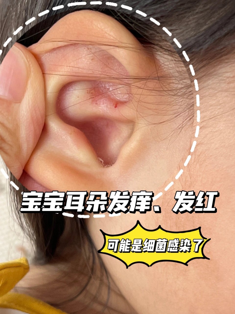 宝宝耳朵痒,又抓又挠,还发烫,挠的红肿 从海边回来,宝宝耳朵👂一直