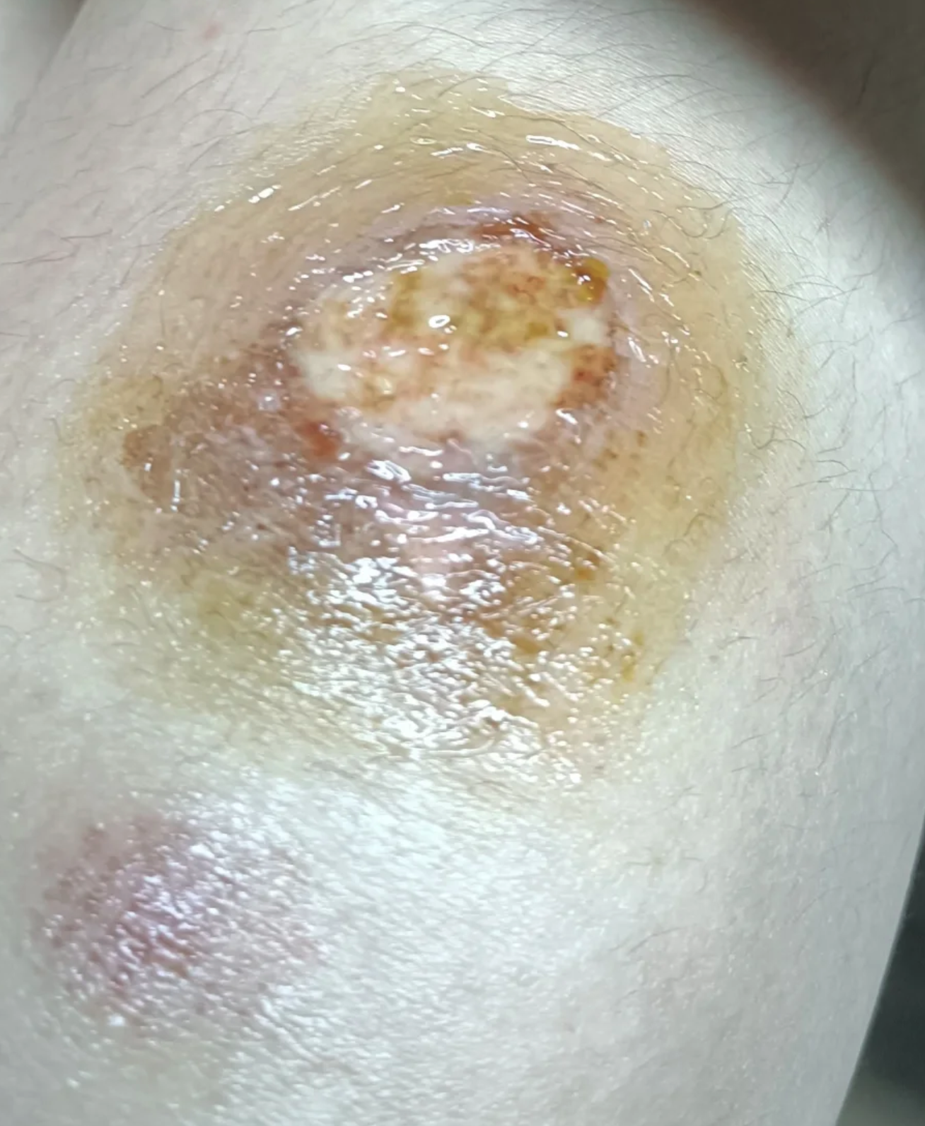 伤口出现白色黏糊糊的东西且愈合不好,常见原因包括炎症或局部渗出