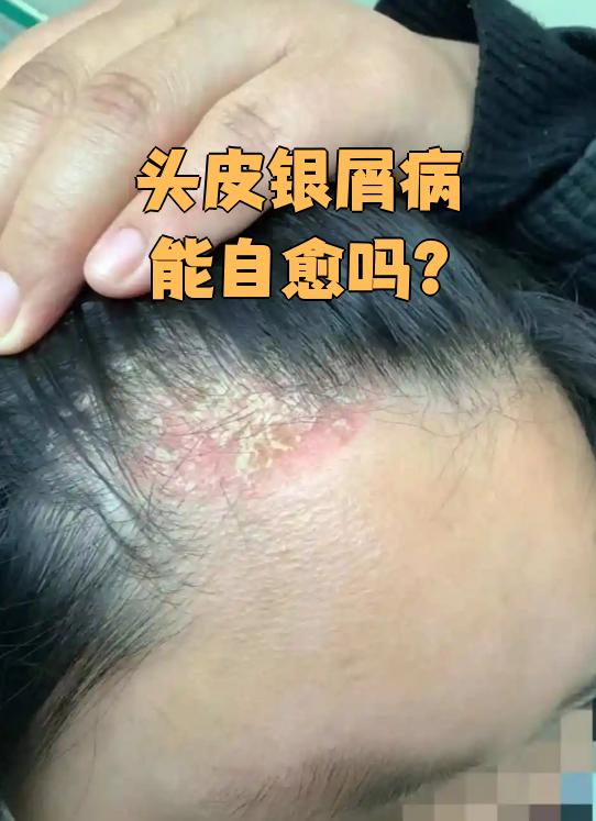 头皮银屑病通常不能自愈,需要规范治疗来控制症状