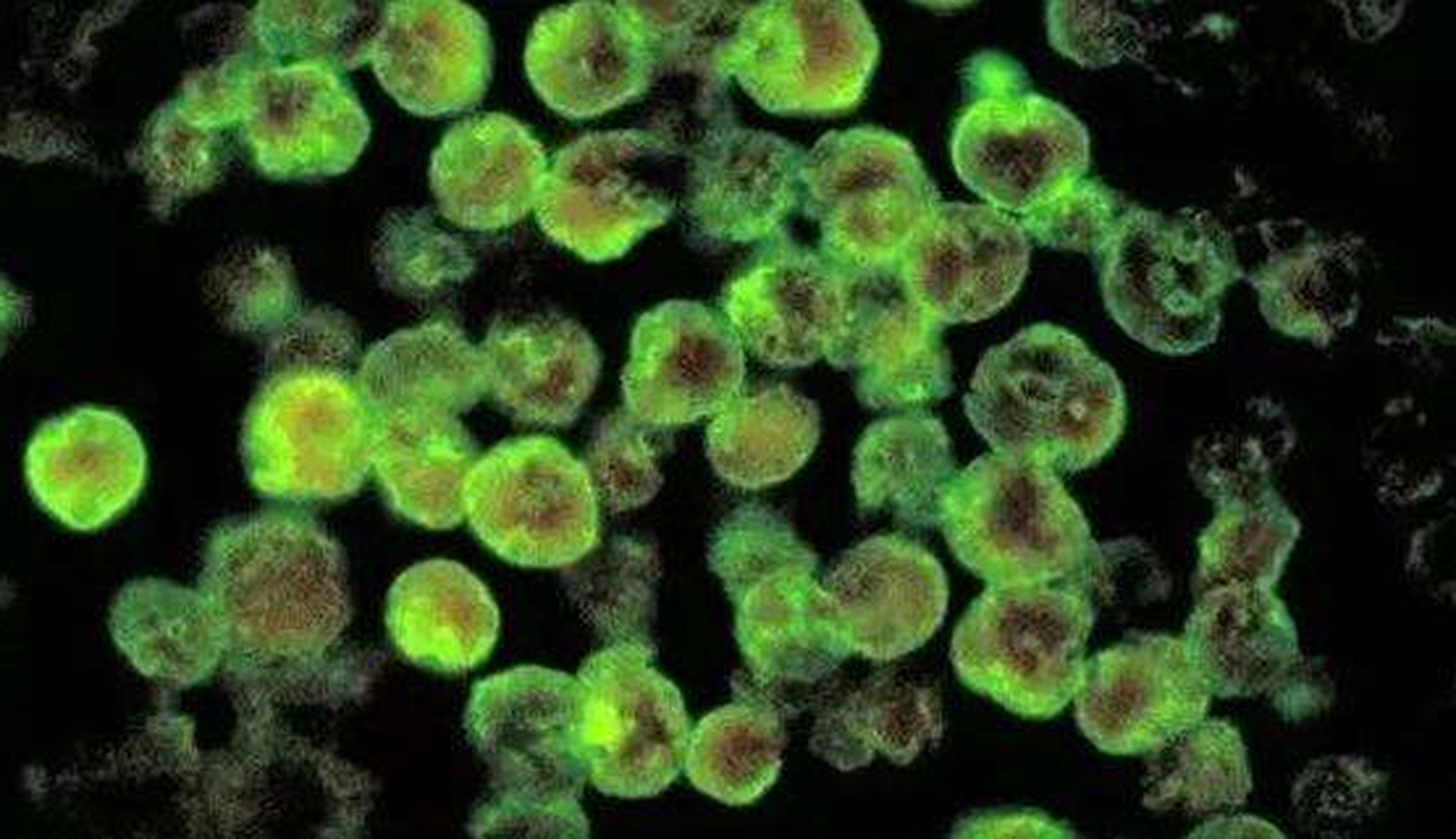 美国再现食脑虫#食脑变形虫能"吃"人脑子,是指原虫进入人脑后,迅速