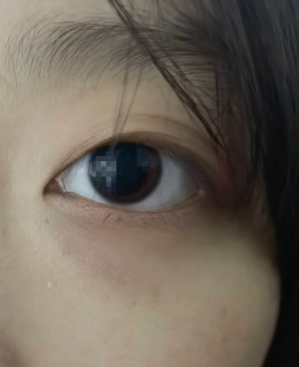 黑眼珠大可能和多种原因有关,下面具体说明常见情况: