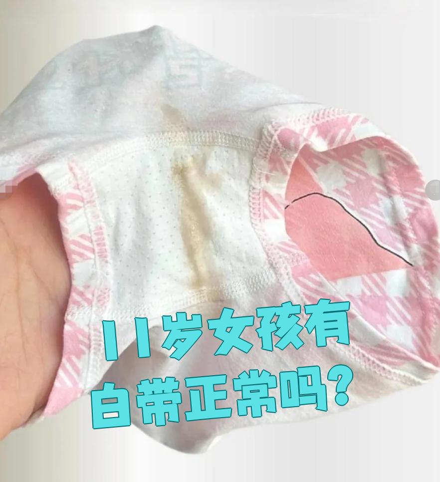 11岁女孩有白带是常见现象,但需要观察具体表现来判断是否正常