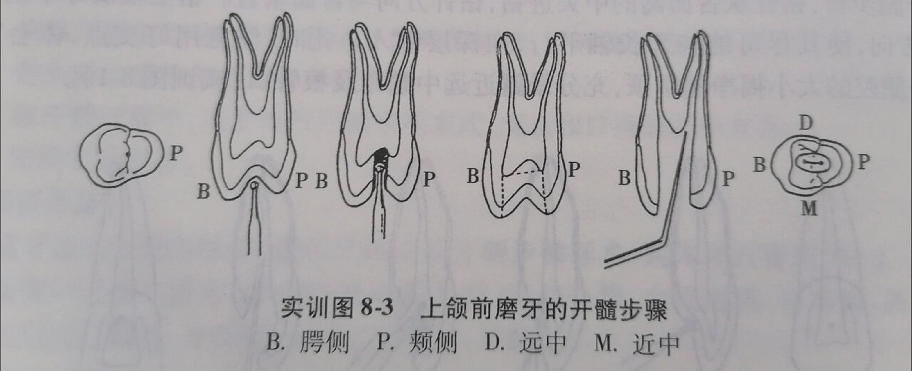 开髓洞型 1上颌前牙 【解剖特点】 一般为单根管 (中切牙)75%(直根管)
