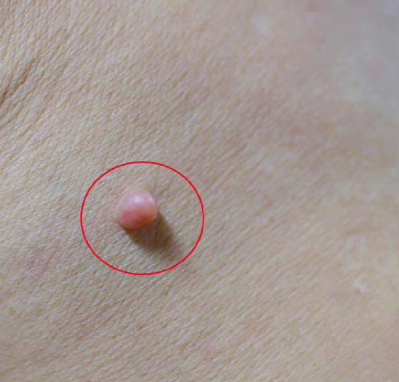 头上和腰背部长出肉疙瘩,它们是一种东西吗 其实它们都是软纤维瘤,一