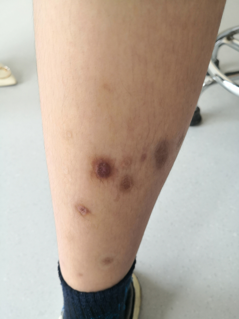 青少年男性四肢躯干散发黄褐色斑块瘢痕.