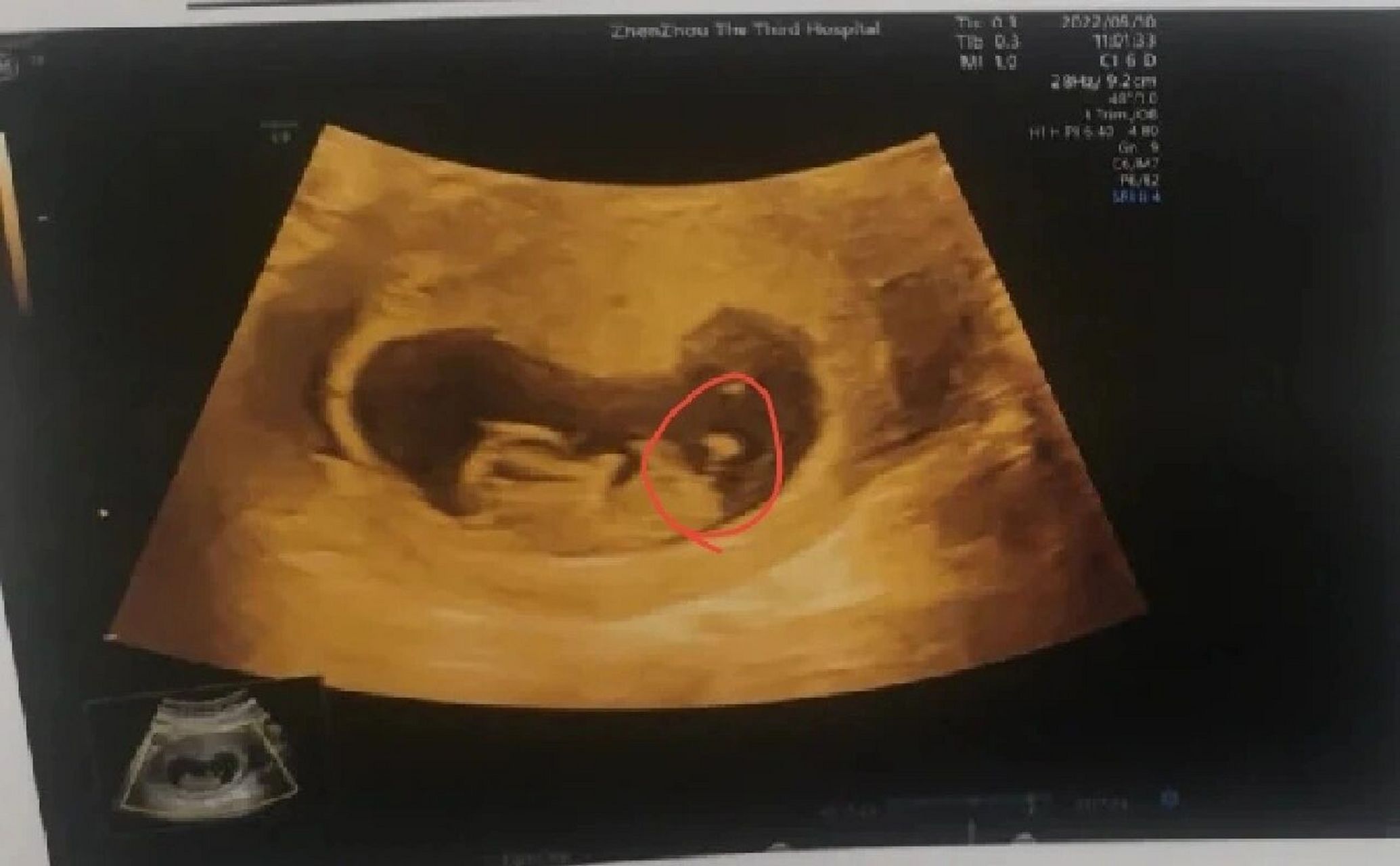 原来9周的彩超单就能看出男女了!