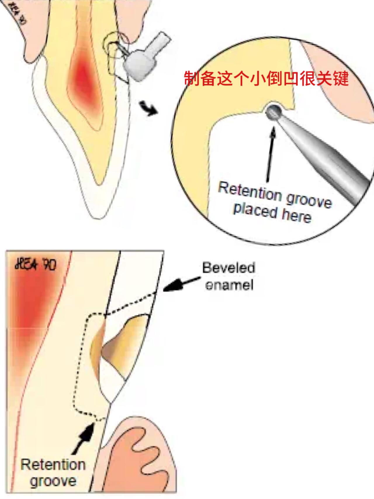 牙齿楔状缺损怎么补才能更牢靠/补牙小技巧 楔状缺损在是很常见的牙体