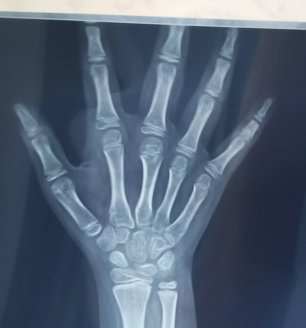 左腕正位显示7个骨化中心,尺桡骨远端骨骺出现,未闭合;双手掌指关节