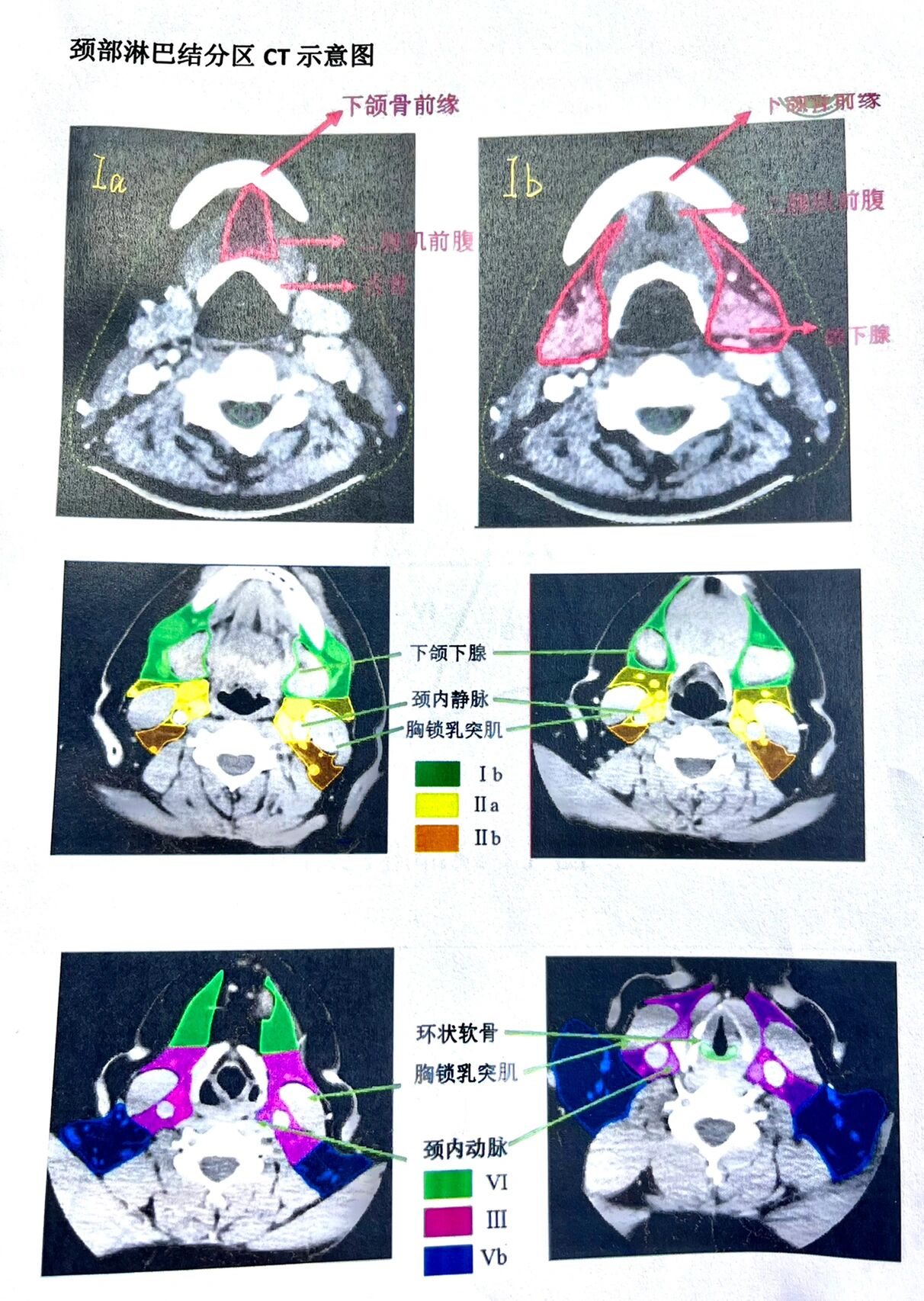 内乳淋巴结ct片图解图片