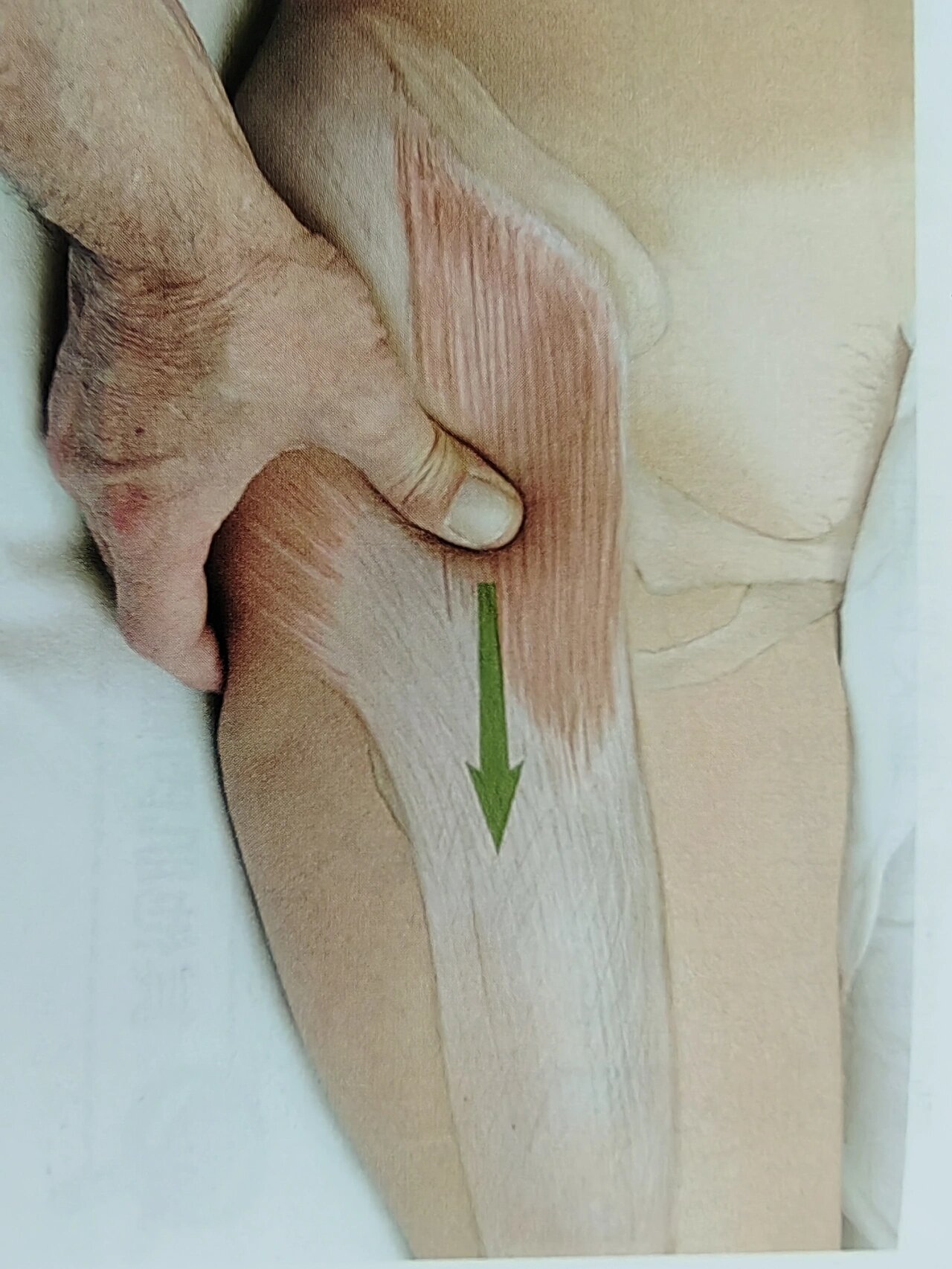 阔筋膜张肌松解手法