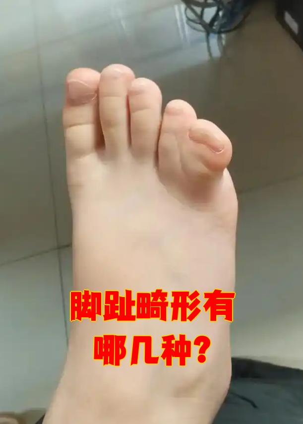 常见的脚趾畸形包括多趾畸形,并趾畸形,巨趾畸形,锤状趾和杵状趾等