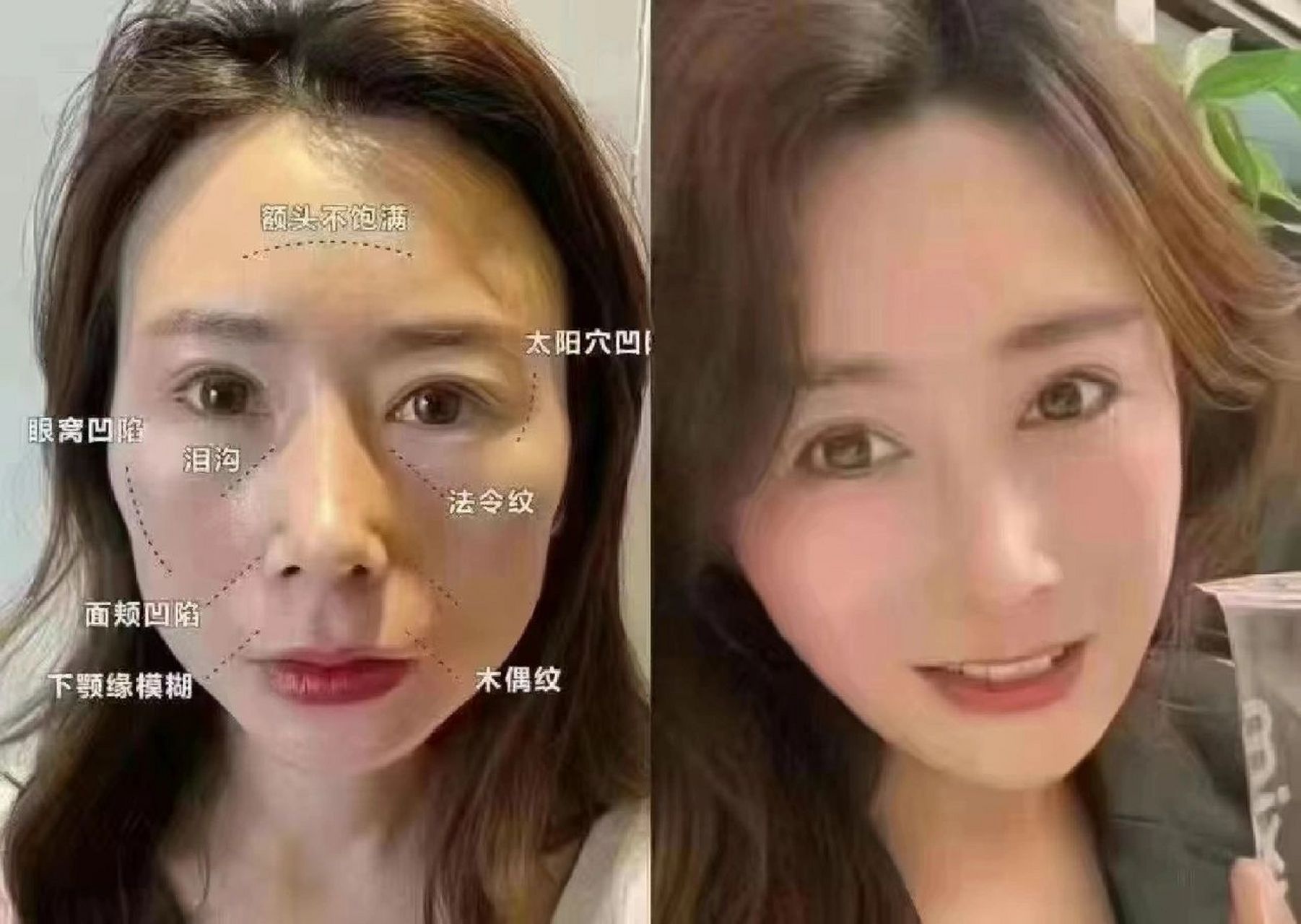 全脸凹陷=苦命人 93 面相大师说,全脸凹陷=苦命人 额头,太阳穴,脸颊