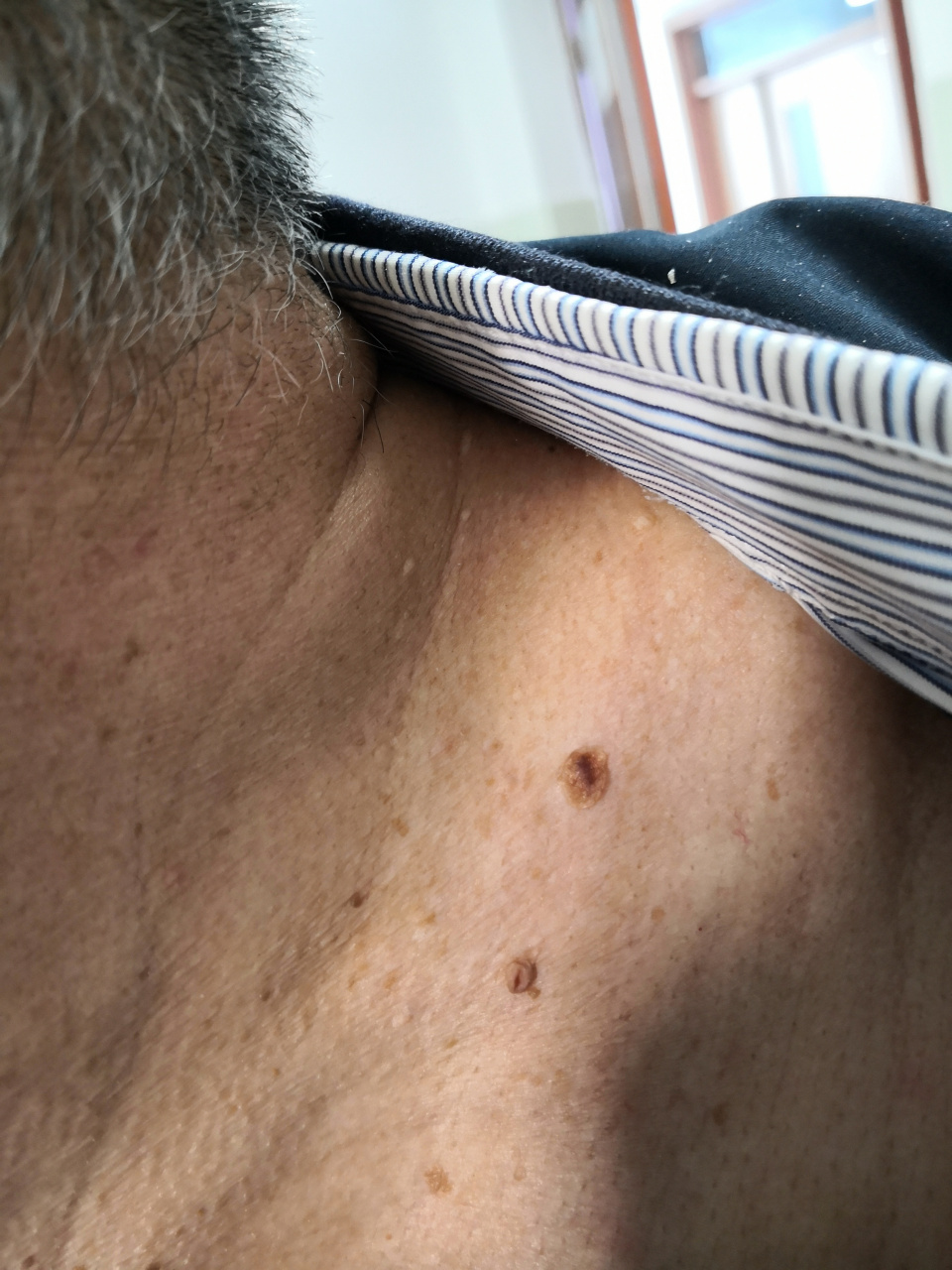 腋下,颈周的皮赘症状.