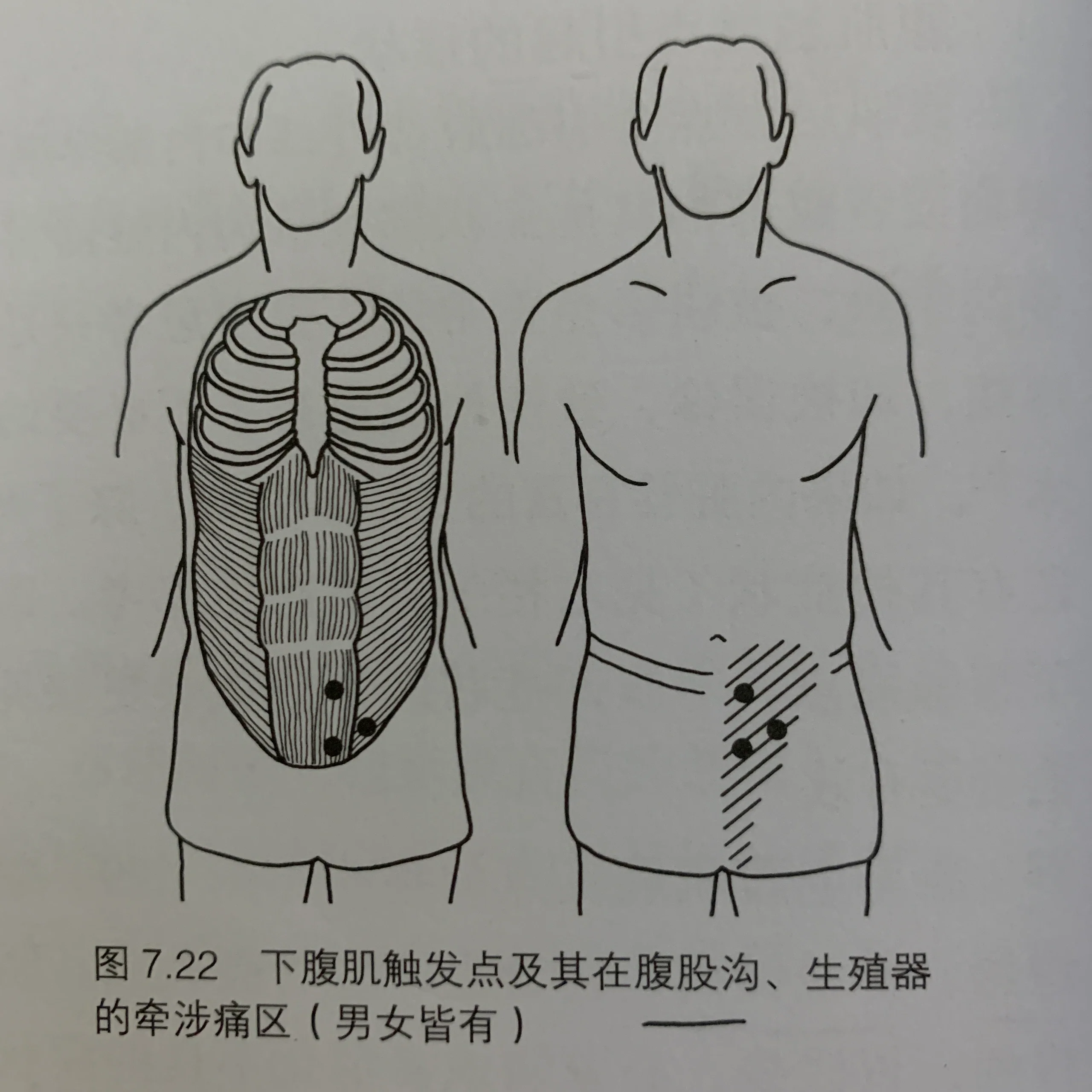 腹股沟疼痛——试试按摩这3️⃣个位置 1️⃣ 耻骨肌 类似