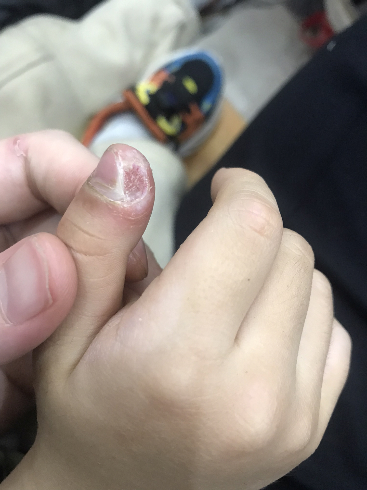 甲周疣治疗第十一天