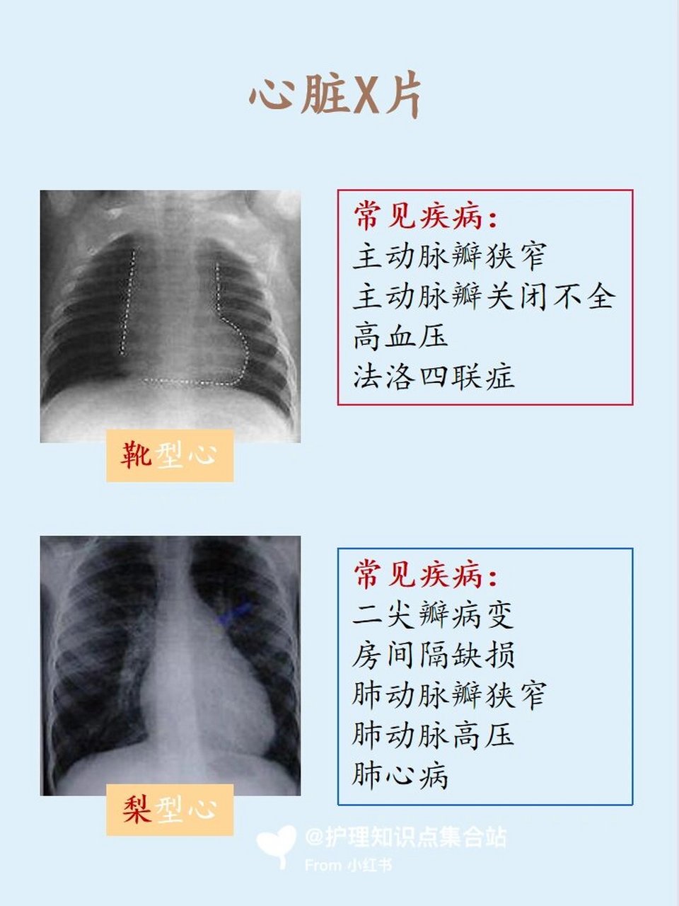 烧瓶心x线图片图片