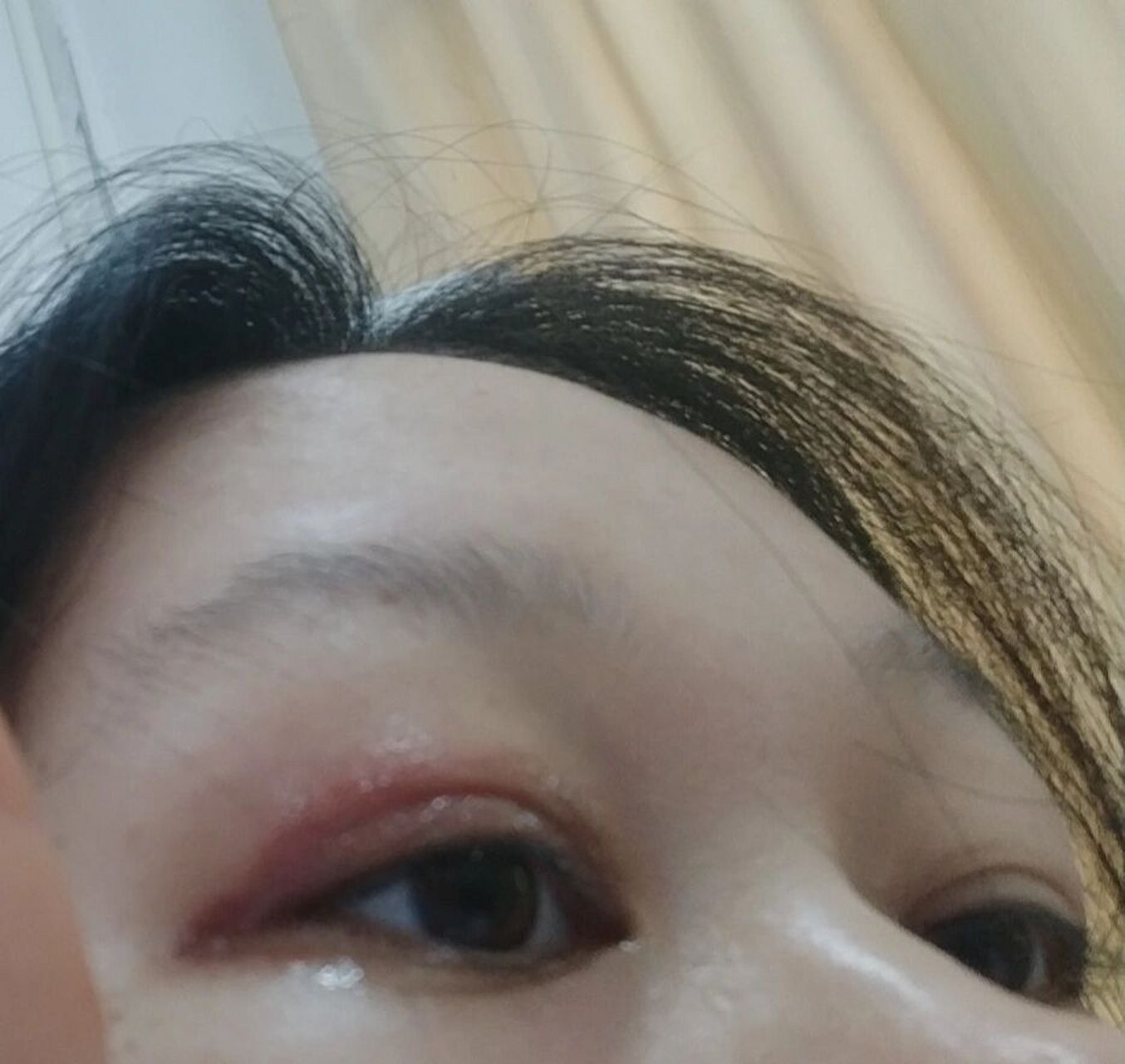 眼睑炎 九月上旬可能是因为贴了双眼皮的原因 上眼皮就肿了,很不舒服