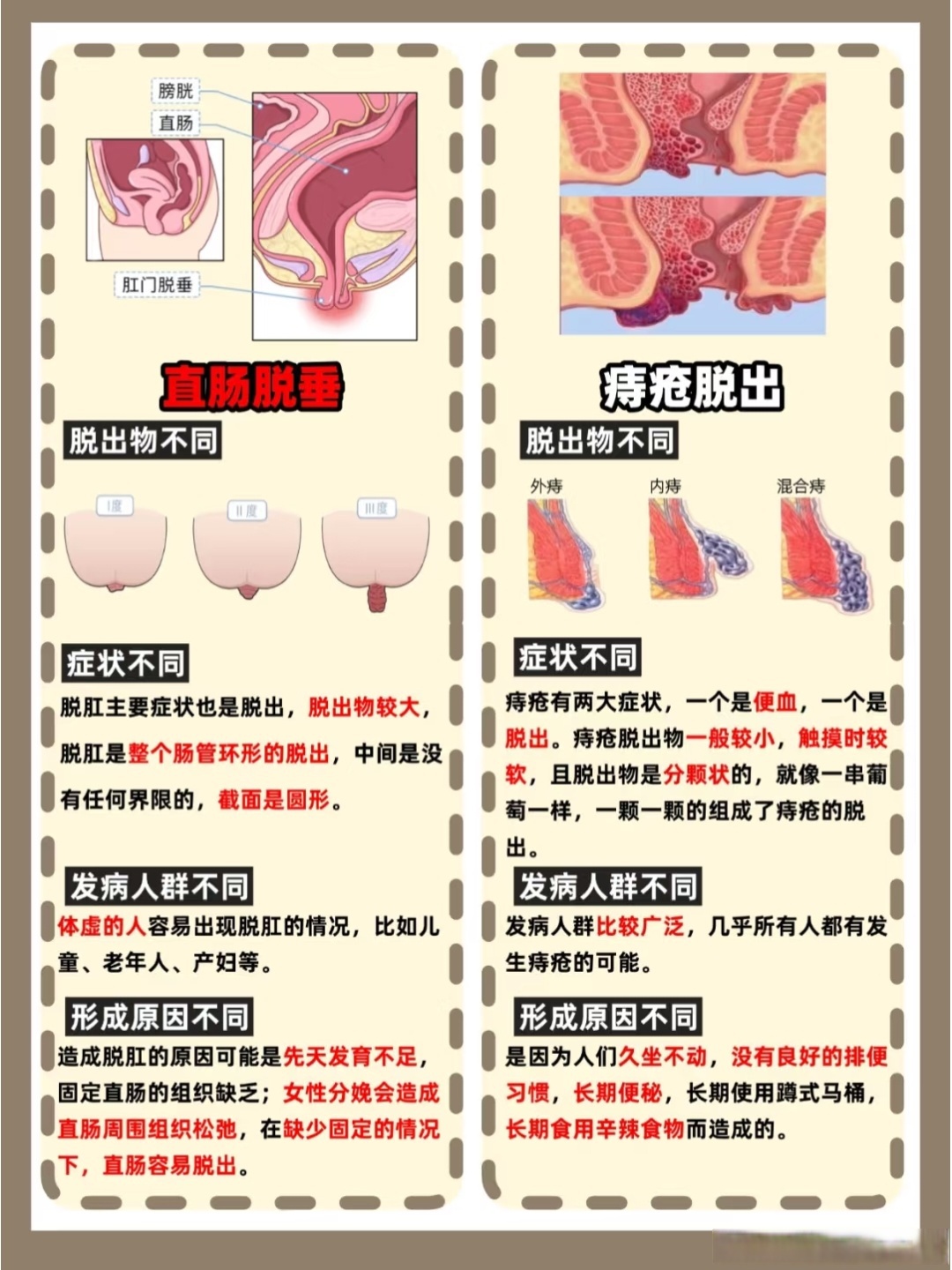脱肛的症状和图片大便时内痔脱出图片直肠脱垂图片和痔疮脱出图片女性