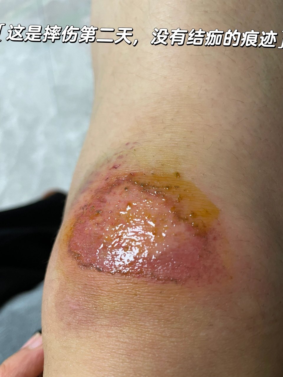 前两天下雨,骑电动车摔了,膝盖破了好大一块皮,就是不结痂,前两天试了