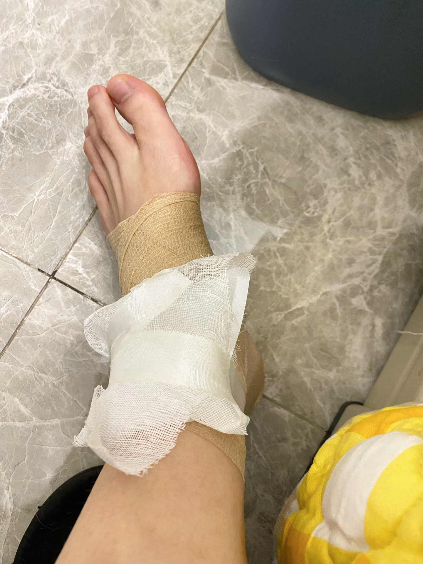 崴脚第二天 包扎技术显著提升