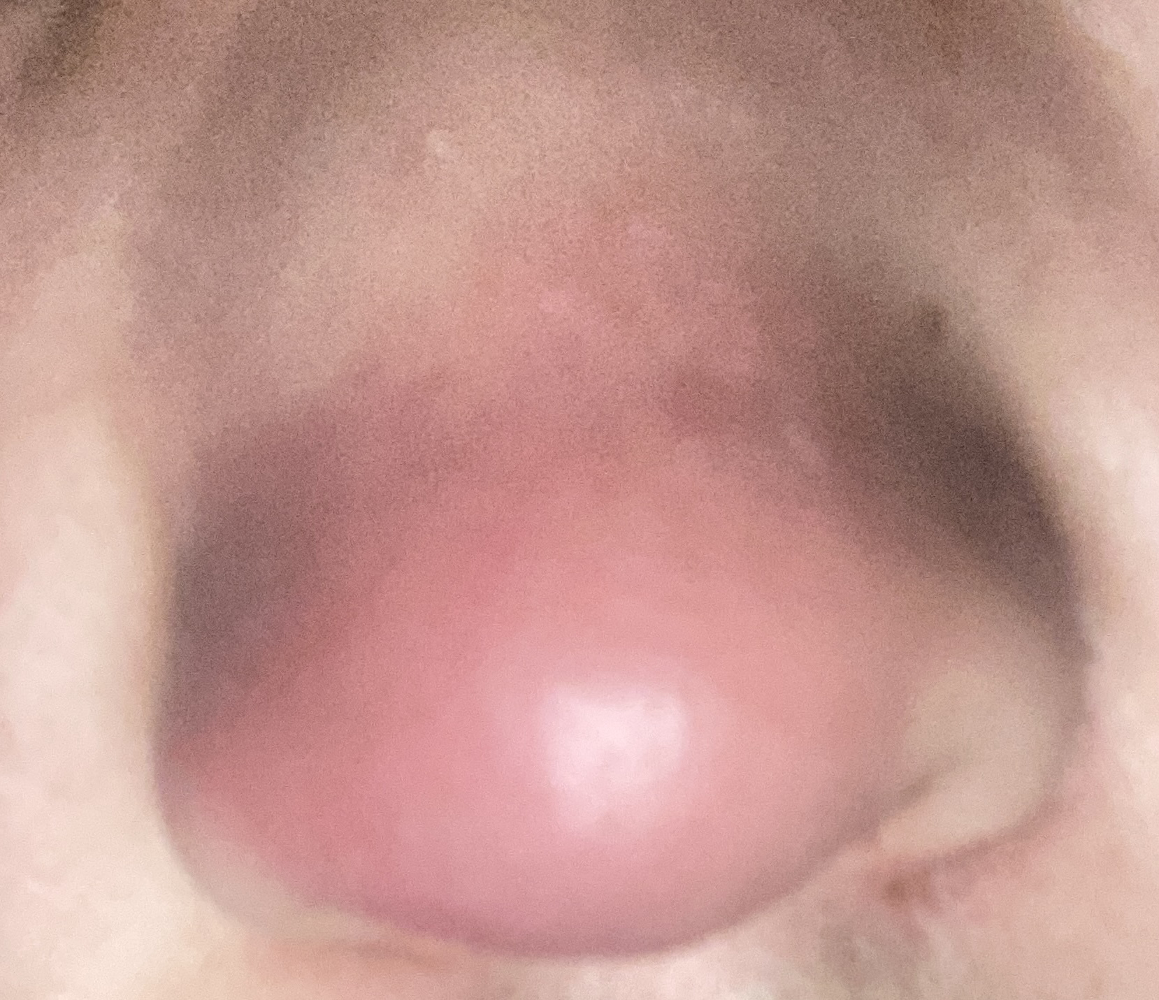 鼻疖千万不要自己挤,也不要乱涂药及时去看医生