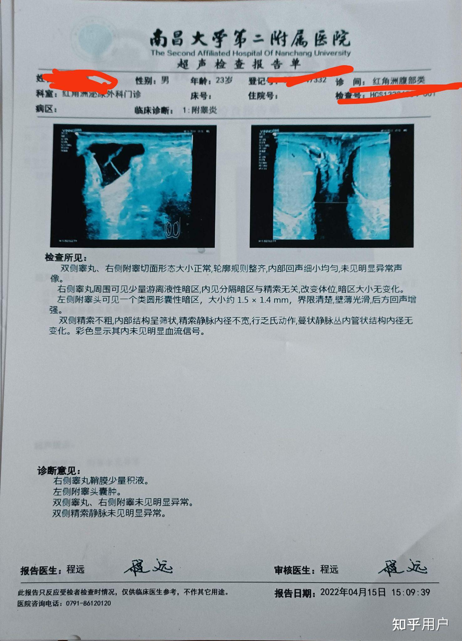 附睾囊肿超声图片