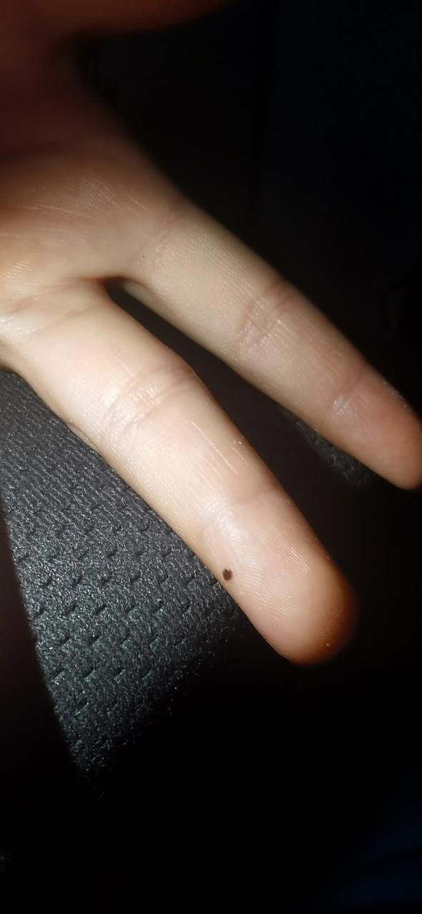 宝宝手指长痣,怎么办啊?