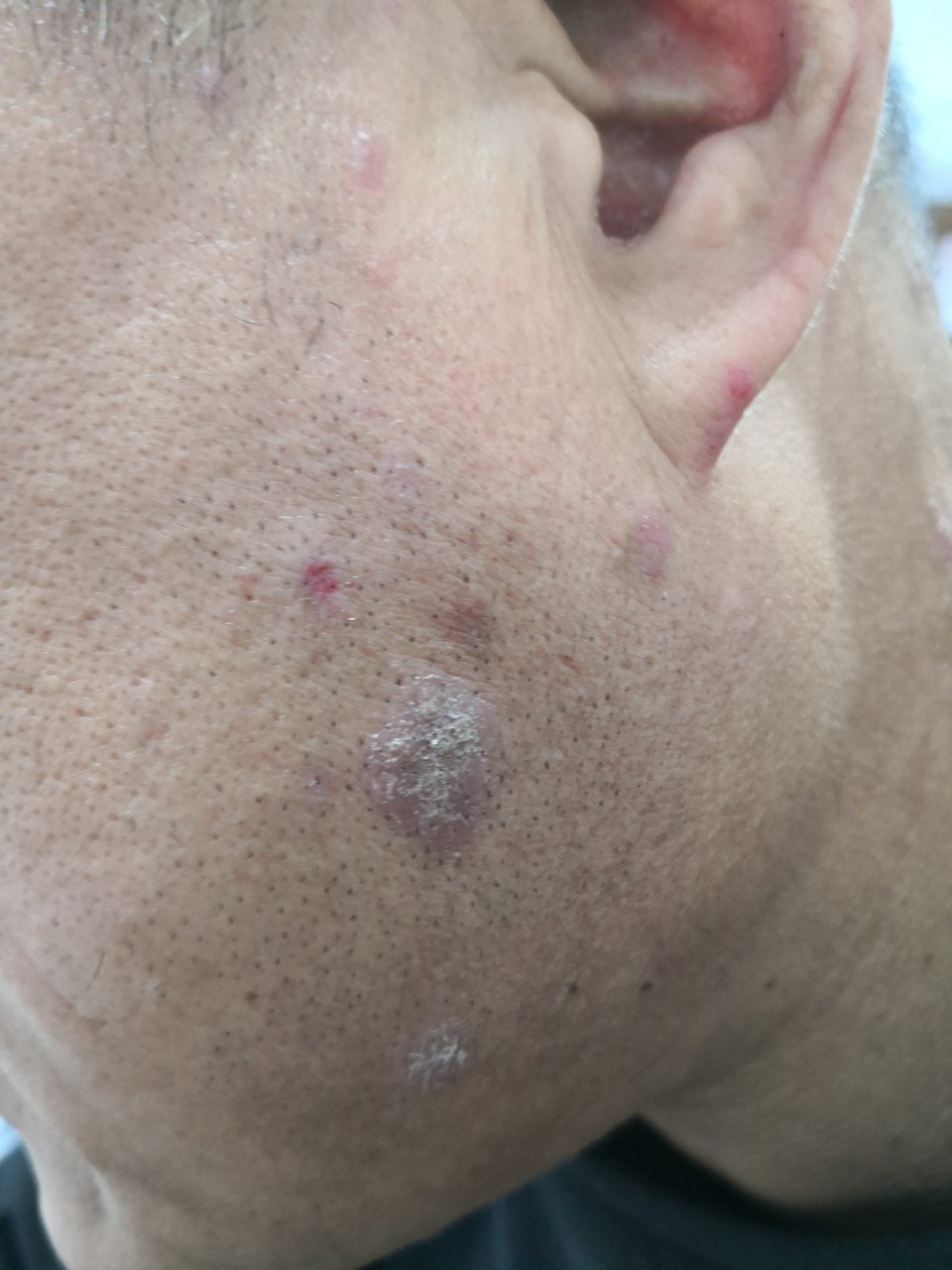 红皮病型银屑病患者使用生物制剂治疗后,银屑病患者头皮面部颈部臀部