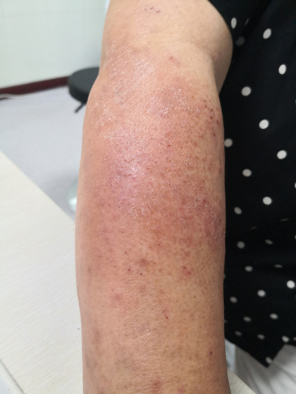 双侧前臂肿胀红斑瘙痒脱屑症状.考虑紫外线过敏导致的光敏性皮炎症状.