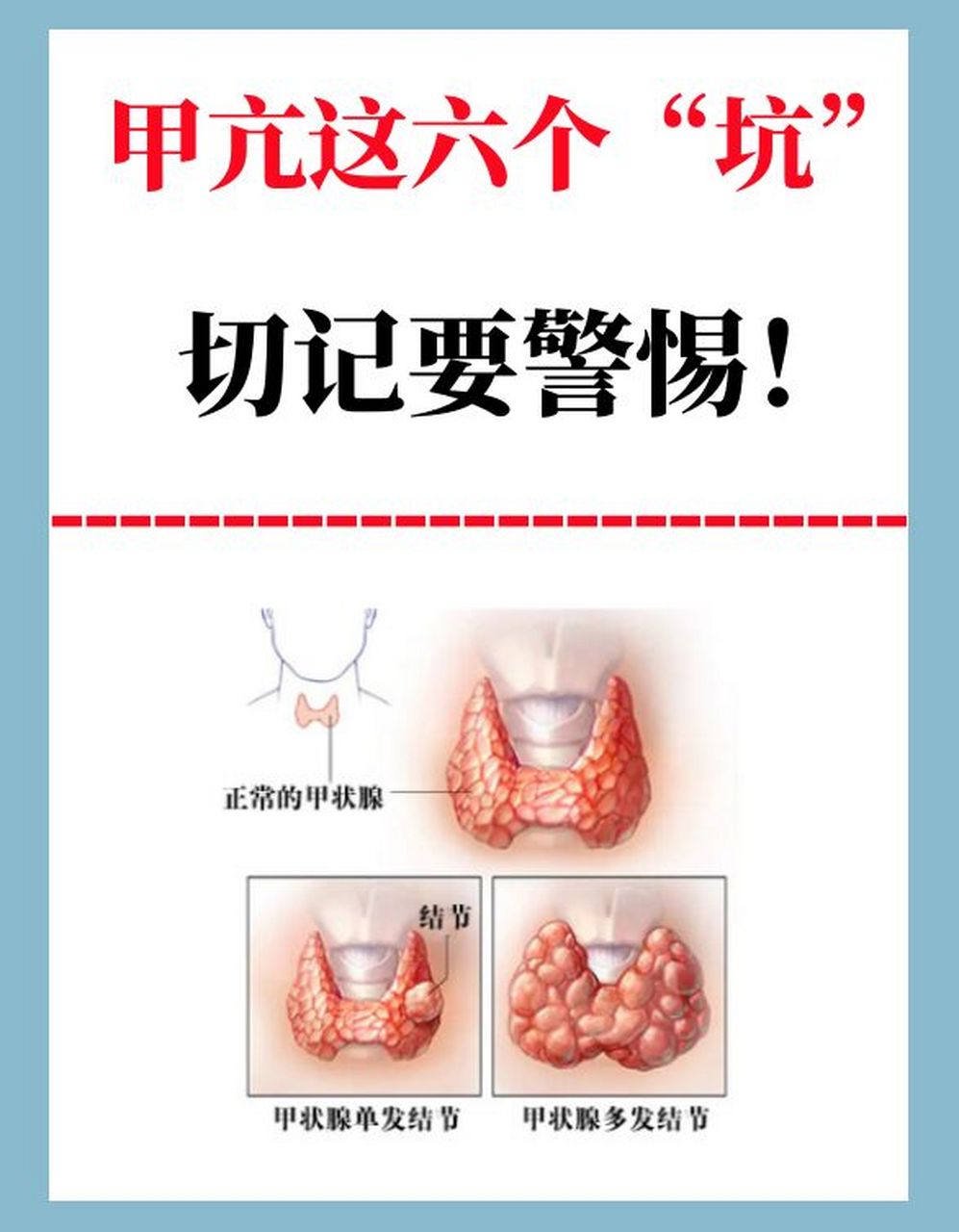 甲亢典型的症状有:甲状腺肿大,眼睛突出,情绪易激动,多言多动,多食易