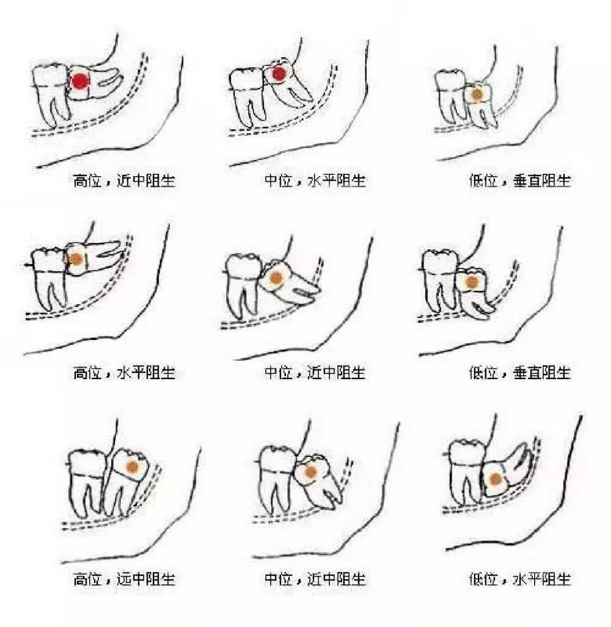 最常见的阻生齿是下颌第三磨牙.