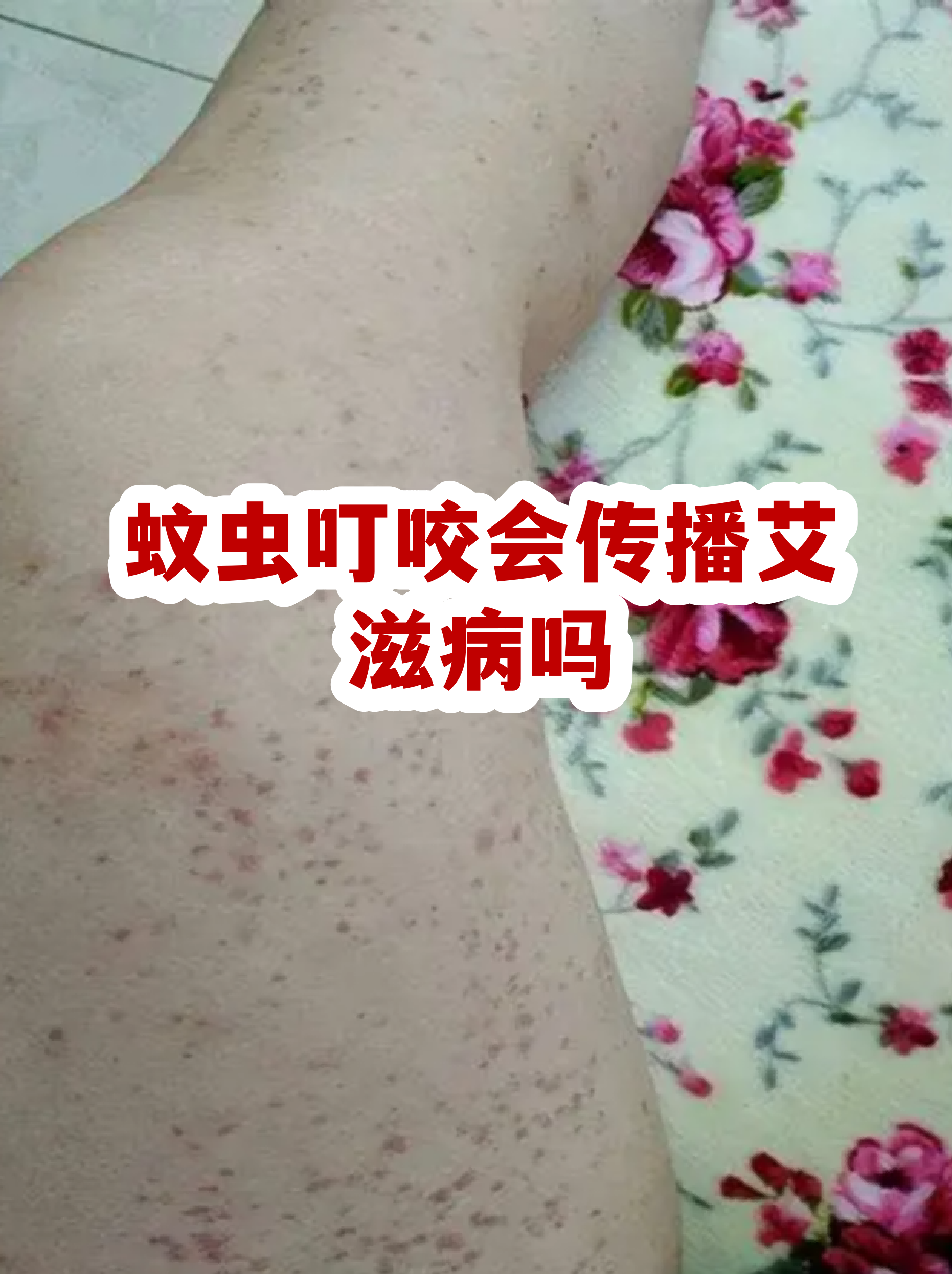  蚊虫叮咬病毒感染(蚊子叮咬会传染艾滋)