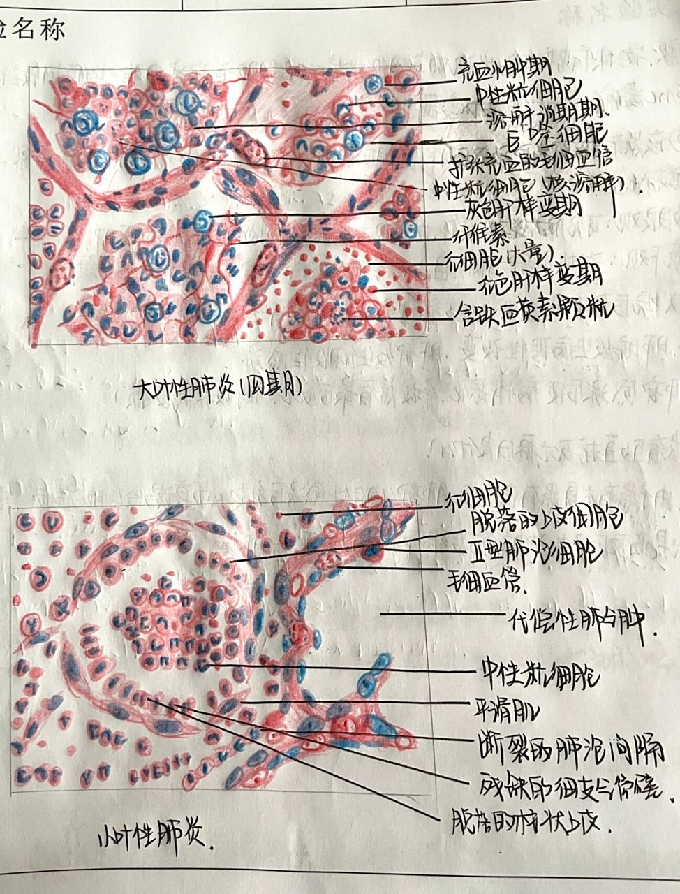 实验报告红蓝铅笔绘图 95是病理学的最后一次实验报告啦 大叶性肺炎