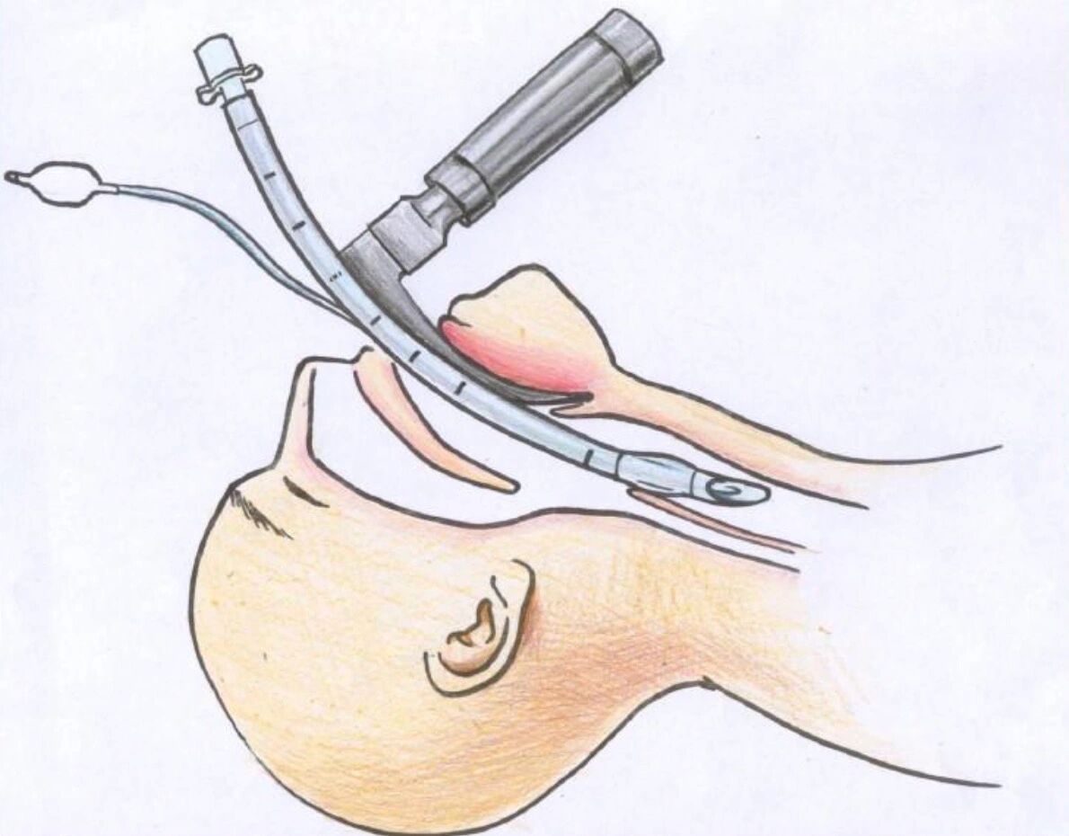 可视喉镜气管插管步骤图片