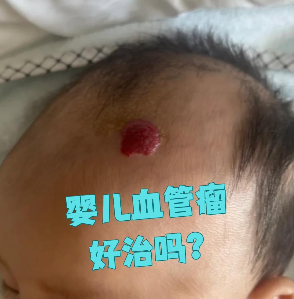 种胚胎时期血管细胞增生引起的皮肤或软组织先天性良性肿瘤或血管畸形