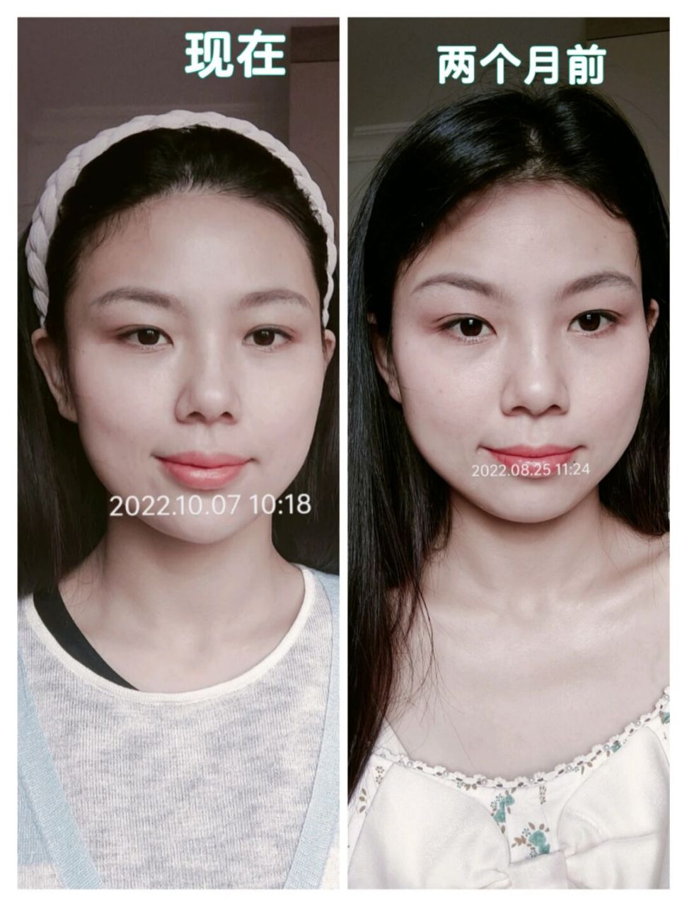 图1是两个月不到前后对比: 图2有点像我18岁的脸,没那么轮廓模糊 图3