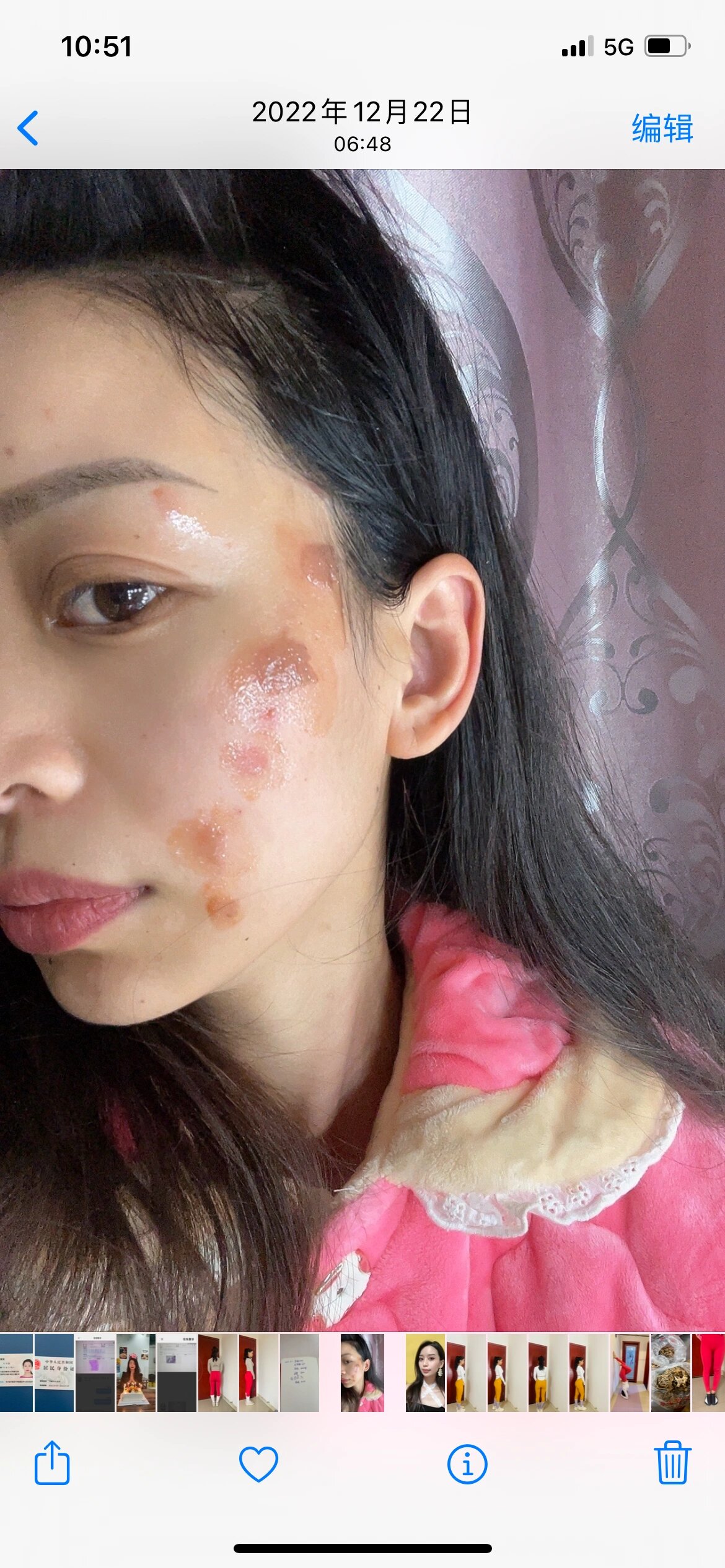 的后遗症 客户烫伤后做了修复, 用了褪黑素产品确实好了, 疤痕很淡了