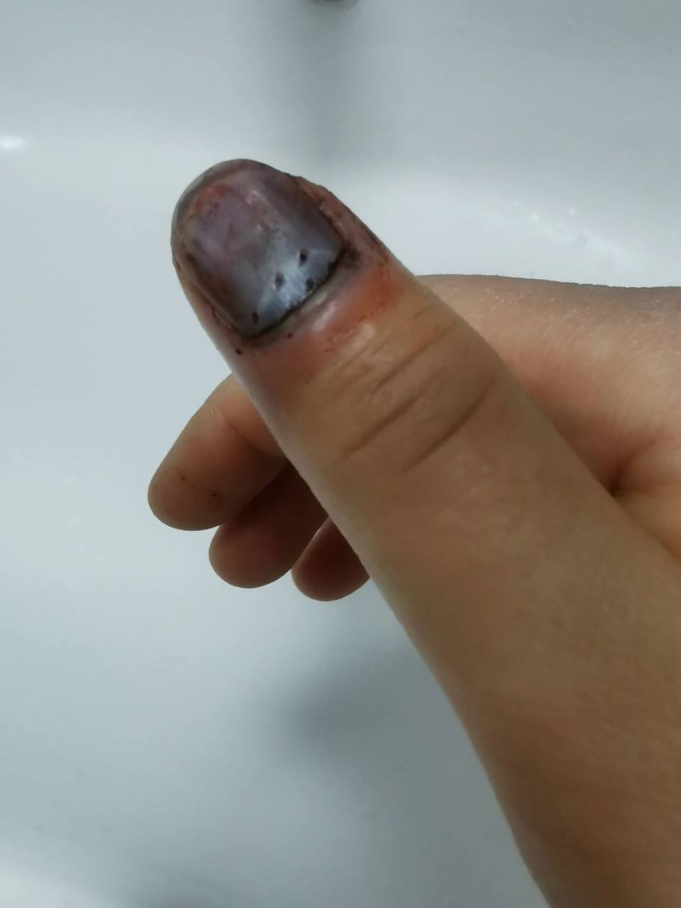 手指被车门夹了,一定要早点去医院放血,可以减轻很多疼痛