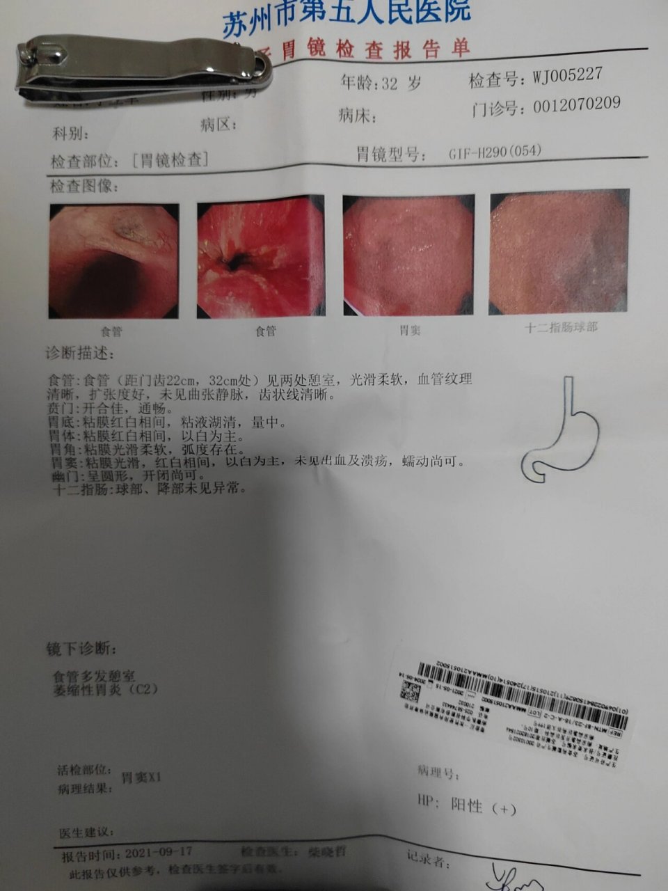 重度慢性浅表性胃炎图片