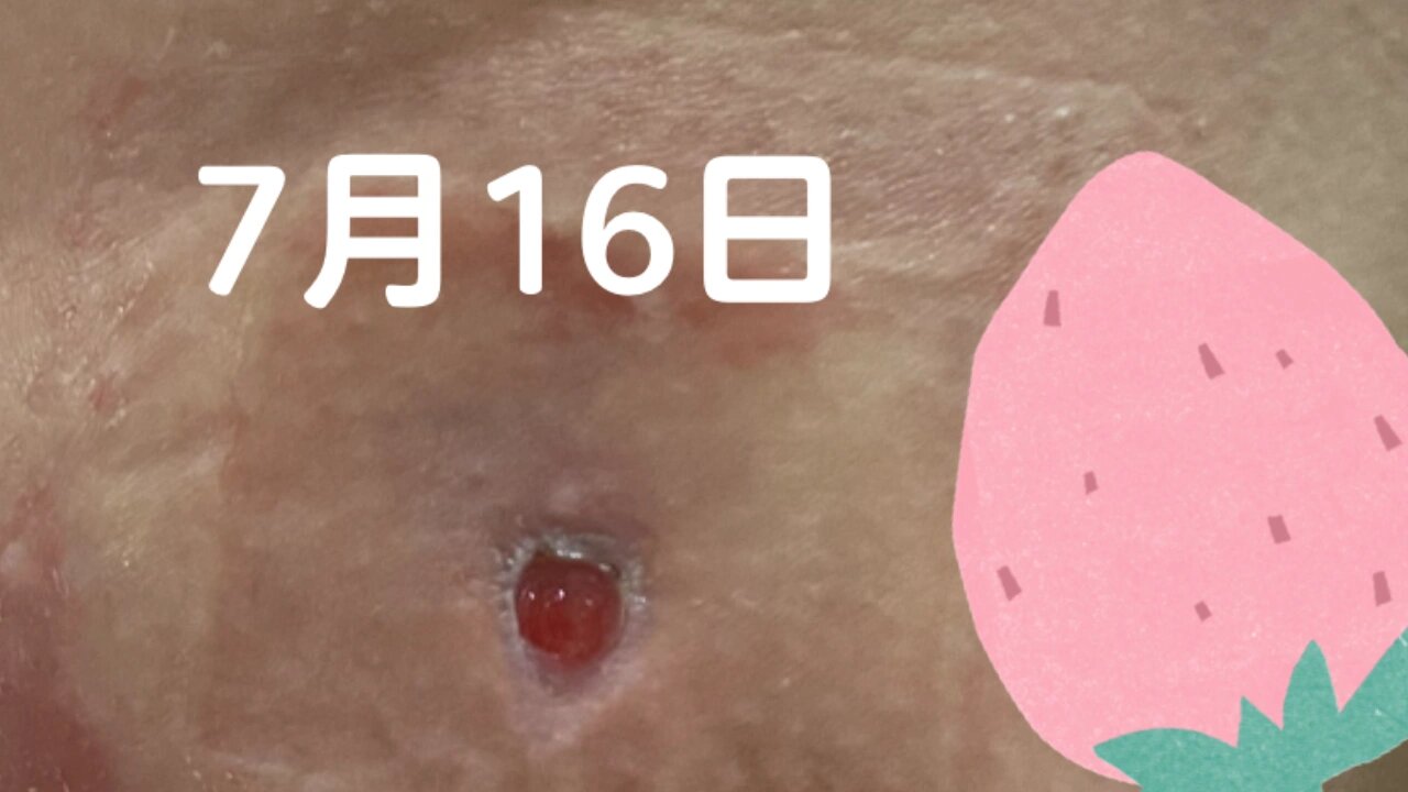 乳腺癌症初期脓包图片图片