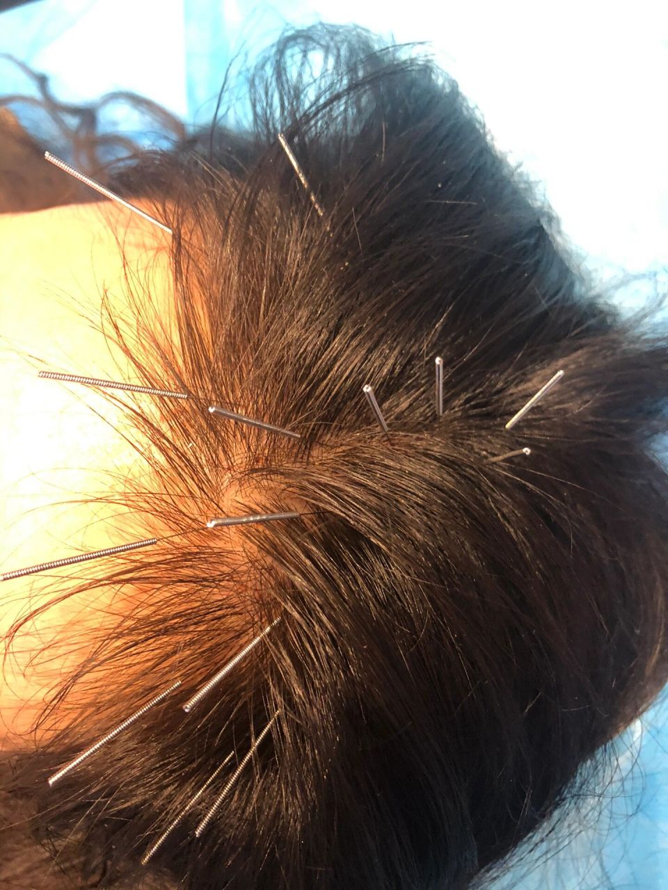 成都殊德中医馆皮肤科张颜老师确实厉害 哇咔咔 不知道是不是心里作用