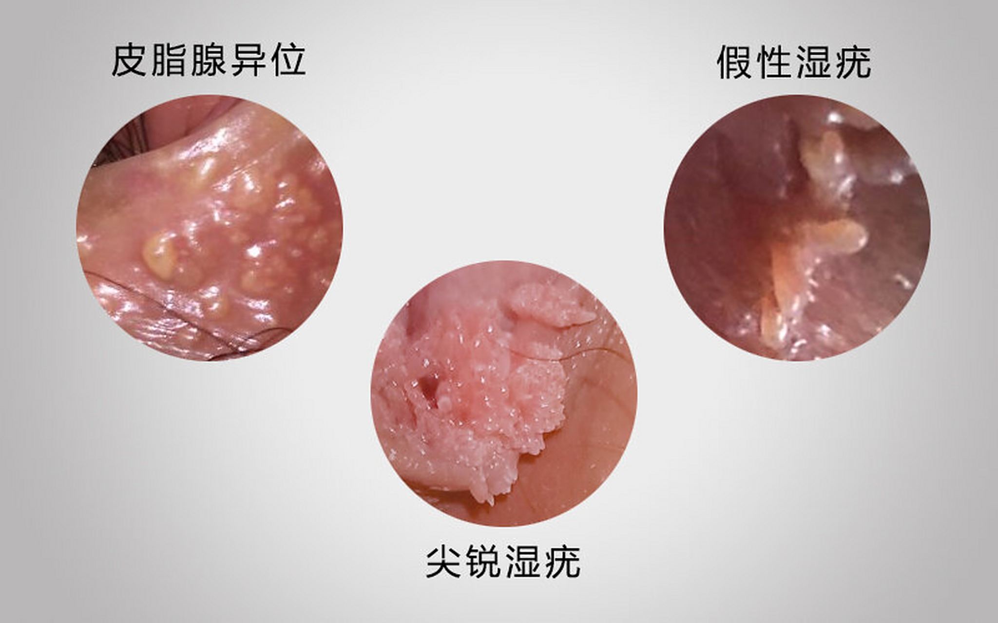 那么女性发假性湿疣和尖锐湿疣到底如何分辨呢?