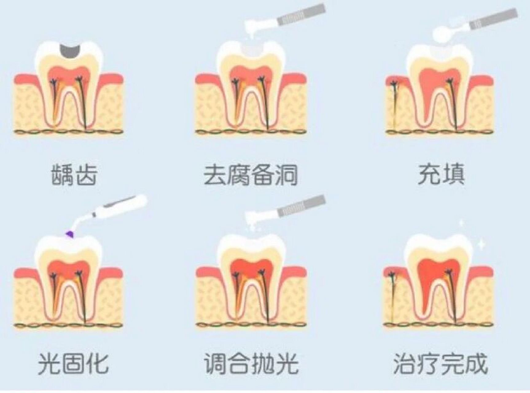 补牙的流程及步骤图片图片